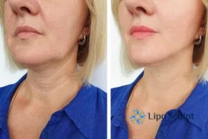 Double chin before and after Hi-Fu treatment 4 Book your double chin treatment Marlow today! We are here to help!