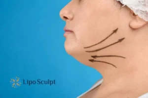 Double chin before and after Hi-Fu treatment 3 Boost your confidence with a Double chin treatment Marlow