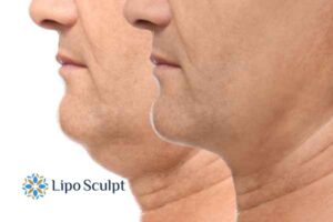 Double chin before and after Hi-Fu treatment 2 Double chin treatment Marlow from Lipo Sculpt - feel more confident today!