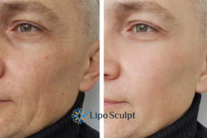 How to Fight Aging Symptoms 3 Fight Aging Symptoms Marlow With HIFU and Morpheus8 Today!