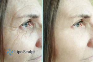 How to Fight Aging Symptoms 2 Do you want to Fight Aging Symptoms Marlow? Contact Lipo Sculpt today!